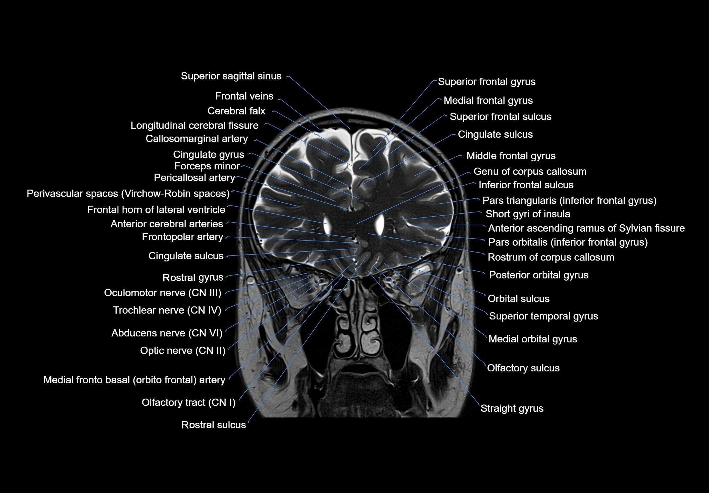 MRI Brain coronal cross sectional labelled anatomy 3T image  -img-00001-00022.webp